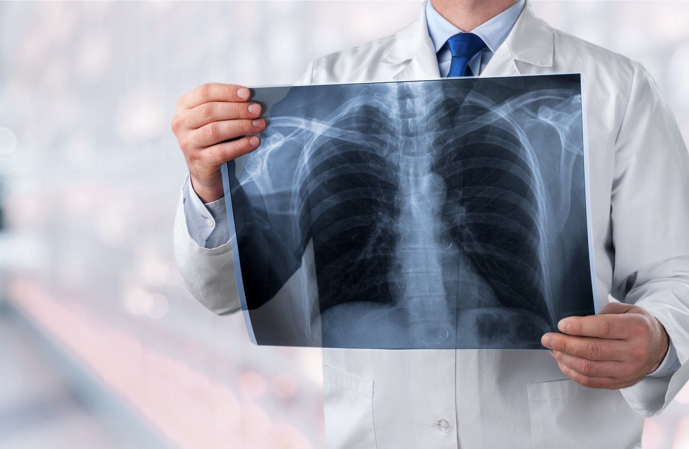  Chụp X-quang phổi giúp phát hiện ra sự bất thường ở phổi